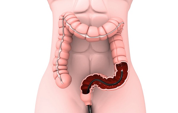 Bệnh Crohn là gì? | PK Bệnh viện Đại học Y Dược 1