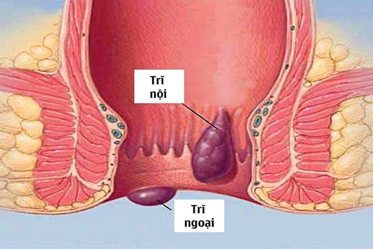 Dấu hiệu bệnh trĩ nhẹ ở giai đoạn đầu