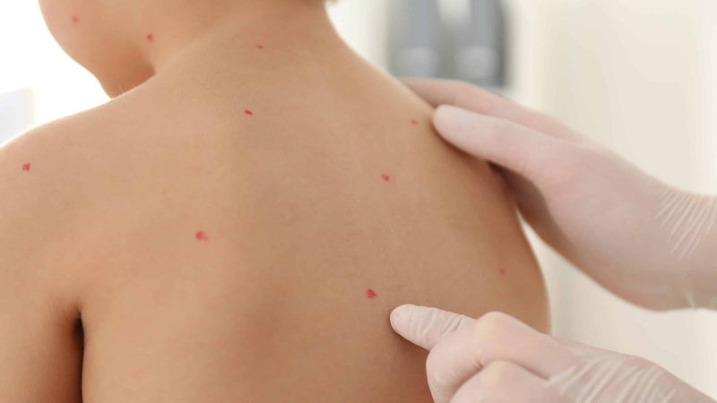 Tổng hợp hình ảnh thủy đậu qua các giai đoạn