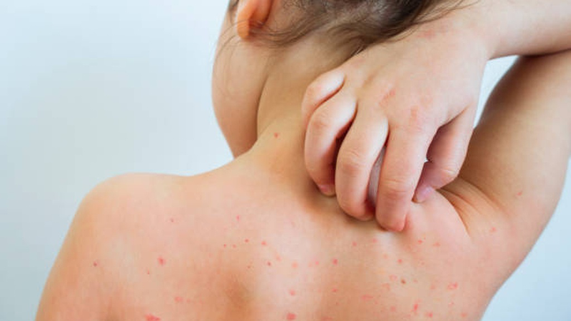 Tổng hợp hình ảnh thủy đậu qua các giai đoạn