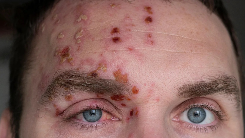 Tổng hợp hình ảnh thủy đậu qua các giai đoạn