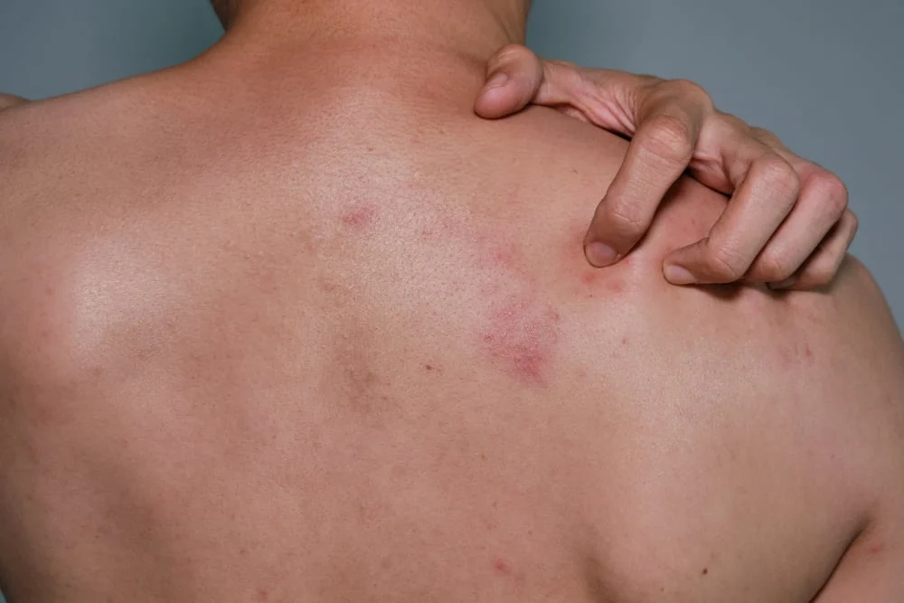 Dấu hiệu bệnh zona sắp khỏi là gì? Hiểu để biết cách chăm sóc