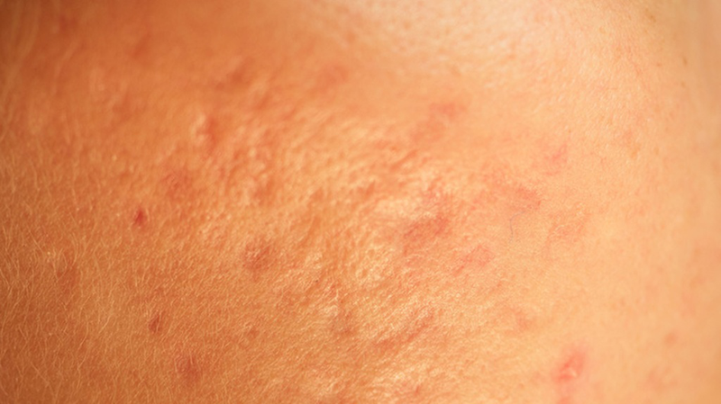 Tổng hợp hình ảnh thủy đậu qua các giai đoạn