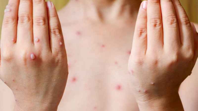 Tổng hợp hình ảnh thủy đậu qua các giai đoạn