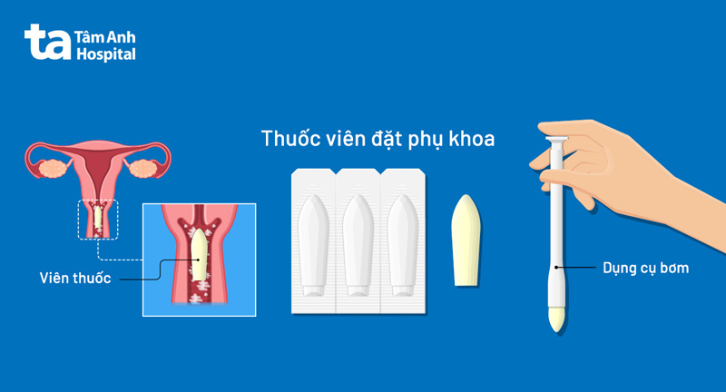 4 thuốc viên đặt phụ khoa (âm đạo): Loại nào giảm viêm tốt?