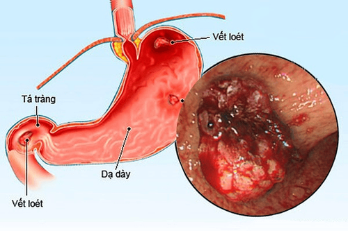 Thuốc dạ dày chữ P - Phosphalugel: Những điều cần biết